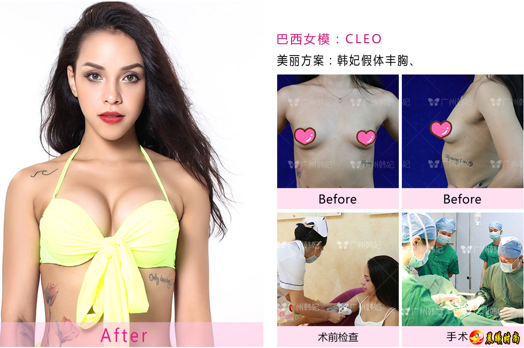 广州韩妃隆胸大咖刘志刚，为你定制3D美胸(图)