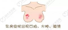 每月一次的自我检查也是尽早发现乳腺癌的基本方法之一
