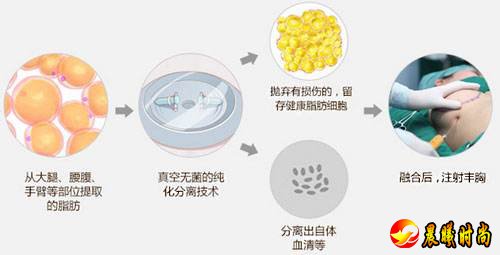 加上移植的脂肪存活能力有限