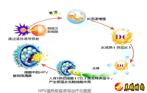 特定波光能免疫诱导疗法：HPV感染治疗新选择